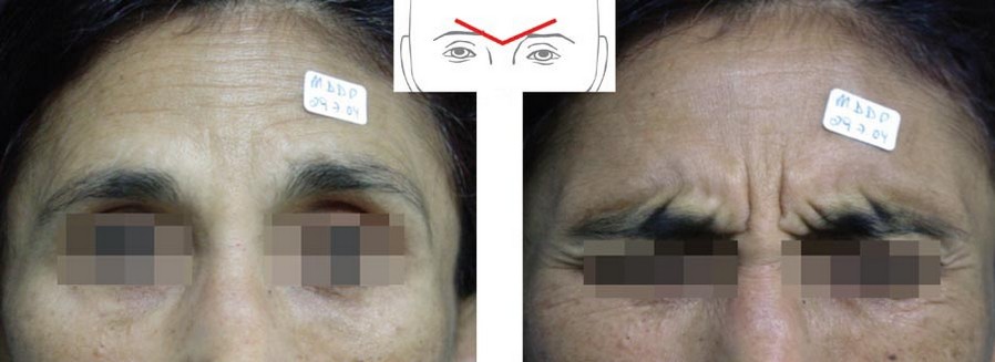 V Tipi glabellar kasılma modeli ve Botoks Tedavisi