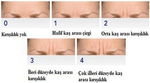 Kaş Arası Botoks Tedavisinde Glabellar Kırışıklıkların Derecelendirilmesi