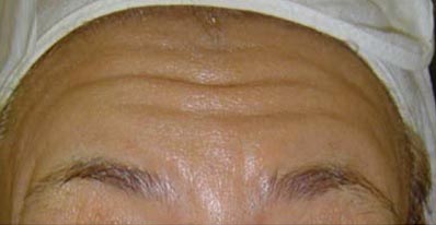 Medial İç Bölge Alın Kırışıklığı Medial Pattern Alın çizgilenmesi