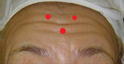 Medial İç Bölge Alın Kırışıklığı Botoks Tedavisi Medial Pattern Alın çizgilenmesi